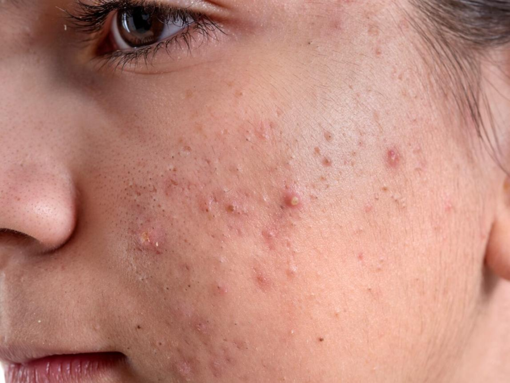 Acne